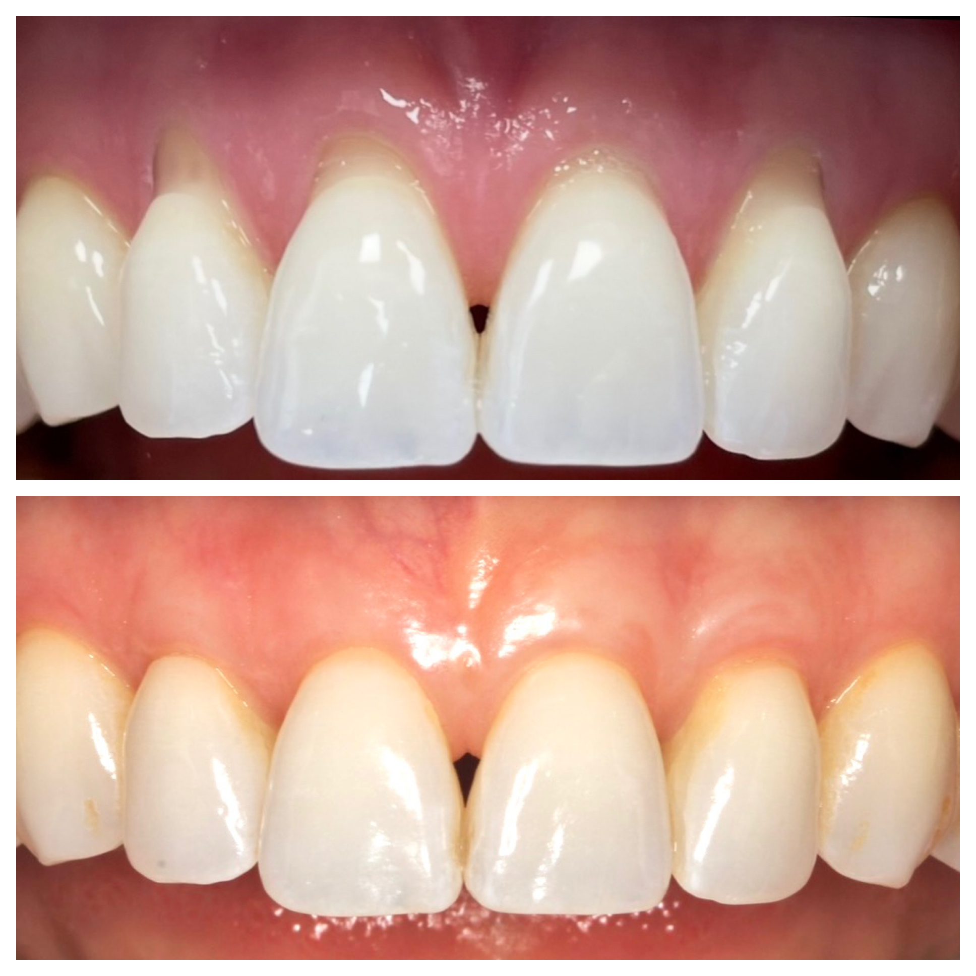 Smile transformation — Beverly Hills